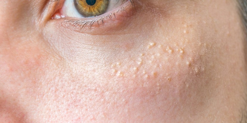 What Is Milia, What Causes It, and How Can It Be Treated?